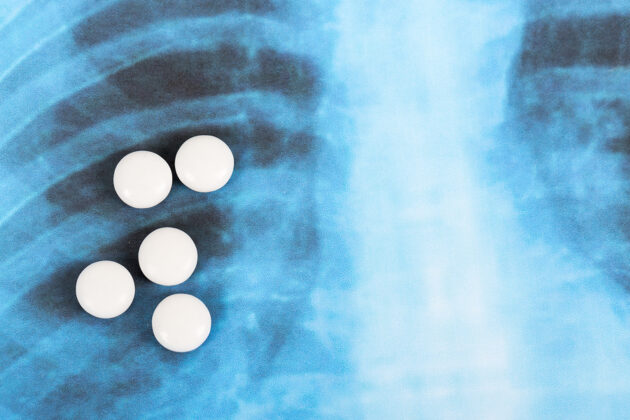 Hydroxychloroquine pills on lung X-ray